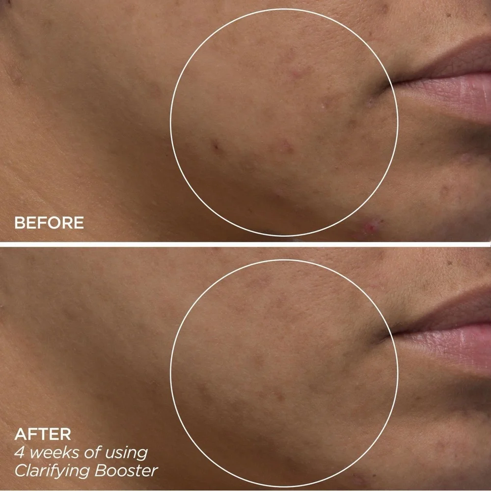 🎀 BEAUTYBIO CLARIFYING Booster | Salicylic Acid Treatment | 1 oz 🎀